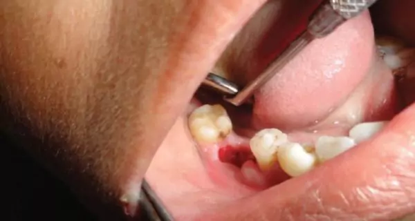 What is dry socket and how can I prevent it?
