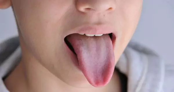 What is lingual papillitis and why does it happen?