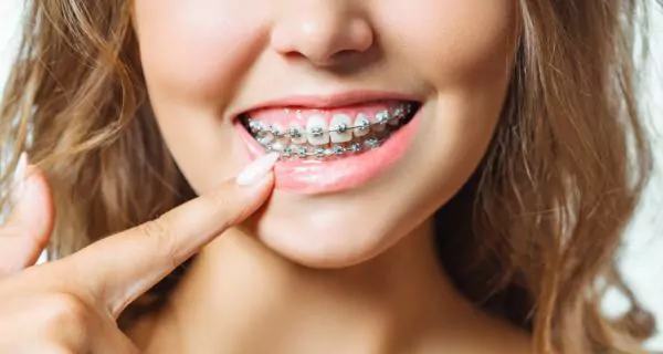 Can braces cause cavities?