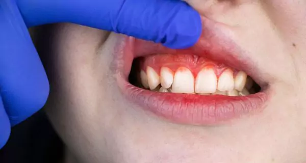 Can malnutrition cause gum disease?