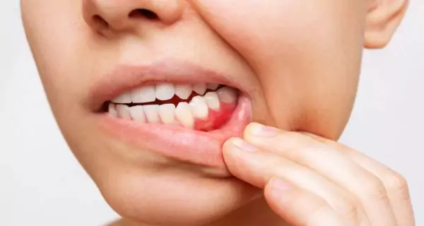 ¿Cómo ayuda el ácido fólico a prevenir la enfermedad de las encías?