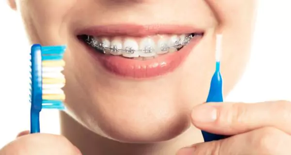 ¿Cómo mantener los dientes sanos con brackets?