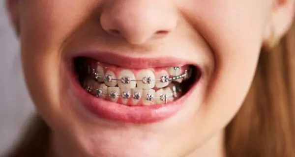 ¿Cómo pueden los brackets propiciar las caries?