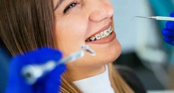 ¿Cómo se tratan las caries durante el uso de brackets?