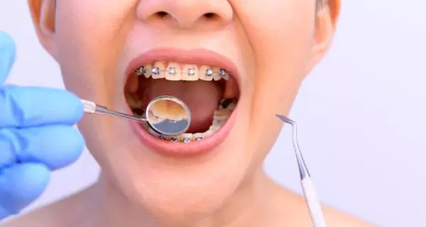 How are cavities treated when you have braces?