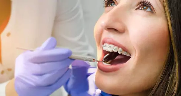 How can I maintain healthy teeth with braces?