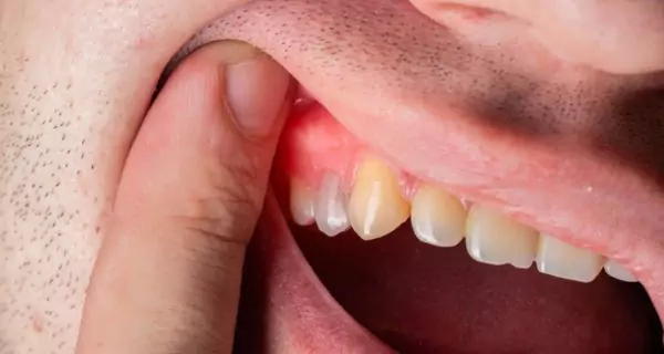 How does folic acid help prevent gum disease?