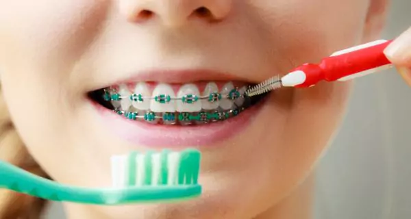 How should you clean teeth with braces?