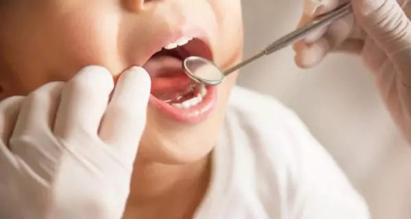 ¿Qué es la caries dental?