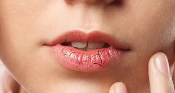 ¿Qué riesgos existen si no cuidas tus labios?