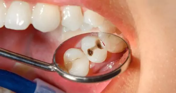 What are cavities? | ¿Qué es la caries dental?