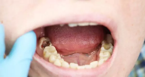 What are cavities and how do they form?