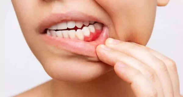 What are the negative effects of multivitamins on teeth and gums?
