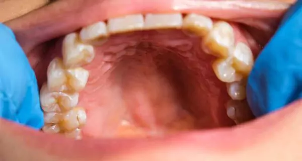 What symptoms should you watch for?