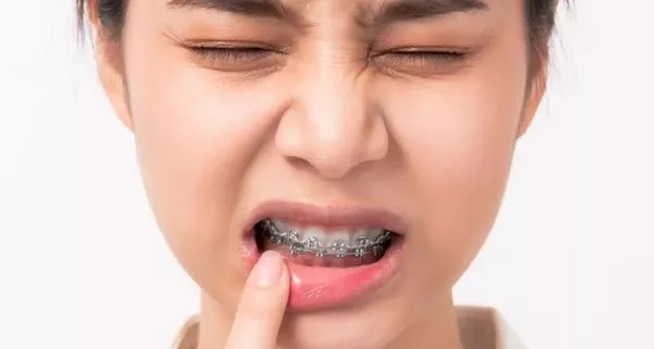 Does nail biting affect orthodontic treatments?