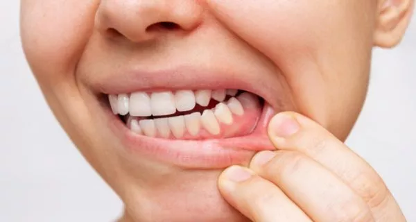 What are the main causes of a gummy smile?