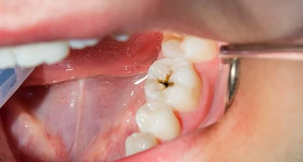 What else can cause bad breath besides cavities?