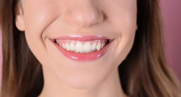 What is a gummy smile?
