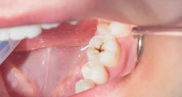 How does Ozempic complicate oral health for diabetic patients?