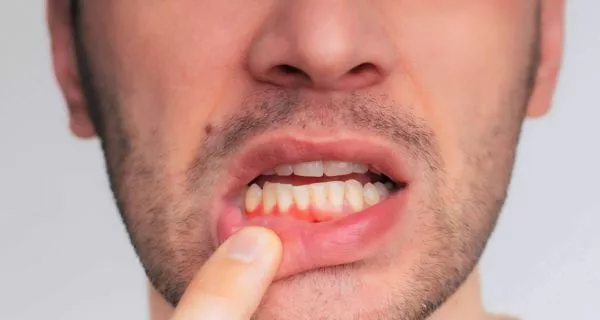 ¿La enfermedad periodontal puede causar cáncer de estómago? 9 ¿Por qué la enfermedad de las encías aumenta el riesgo de cáncer de estómago?