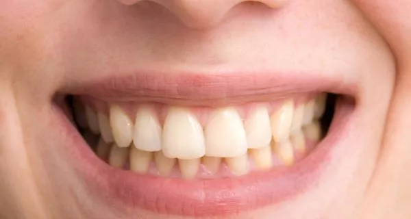What Is the Natural Color of Teeth and How Can You Protect It? 9 What determines the natural color of teeth?