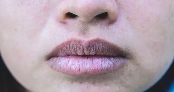 ¿Por qué tengo sabor salado en la boca? Causas y qué hacer 25 1. Boca seca (Xerostomía)