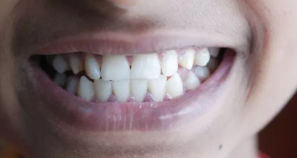 Is Teeth Shaving at Home Safe or Dangerous? 15 Occlusion may be affected