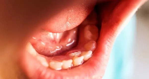 Tratamiento para la ránula: opciones integrales y efectivas 10 Types of Ranula