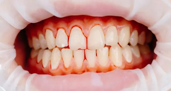 What Is Trench Mouth and Why Is It Dangerous? 8 What is a trench mouth?