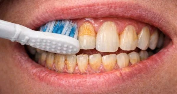 ¿Qué son las lesiones cervicales no cariosas? 7 What is Abrasion?