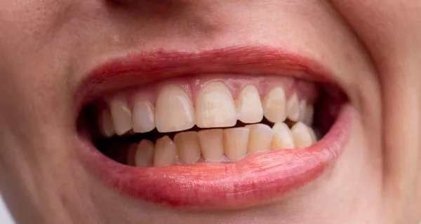 ¿Qué son las lesiones cervicales no cariosas? 8 What is Erosion?