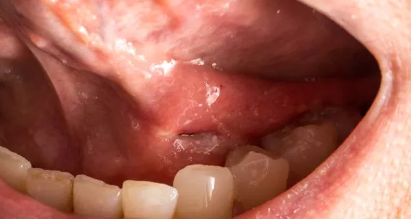 Tratamiento para la ránula: opciones integrales y efectivas 9 When a lump appears under your tongue