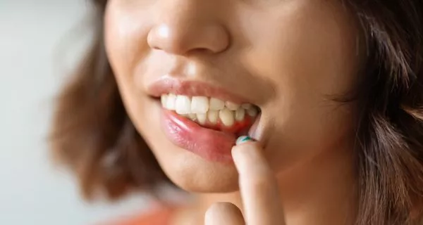 What Is Trench Mouth and Why Is It Dangerous? 9 Why does a trench mouth appear?